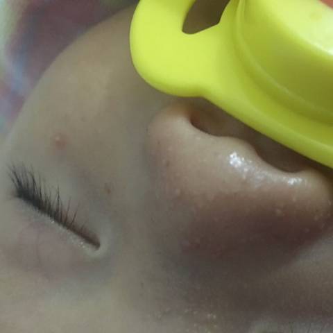 一岁宝宝鼻子旁边长一粒粒小豆豆是什么？全面解析与应对建议