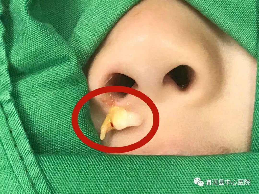 关于一岁娃鼻孔长出豆芽现象的深度解析