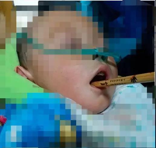 幼儿被筷子刺穿口腔后该怎么办？全面解析应急处理措施