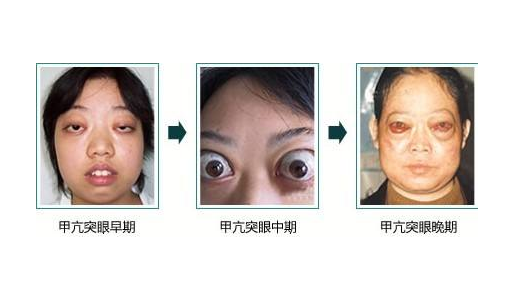 甲亢博主，引领健康潮流，传递正能量