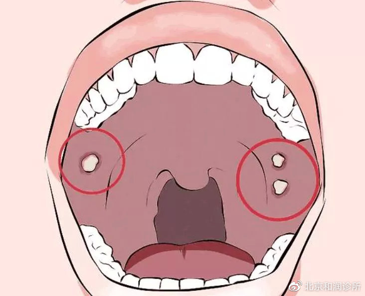 口腔溃疡与HPV，并非同一概念