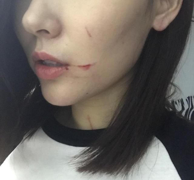 男粉丝咬伤女主播嘴，赔十万变赔十5？网络热点深度解析