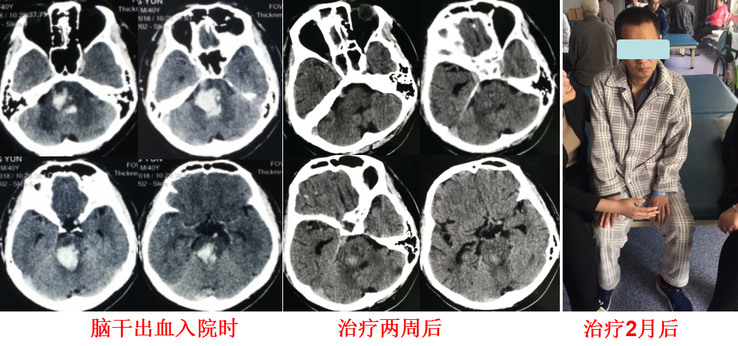 脑干出血死亡过程视频，深度解析与理解