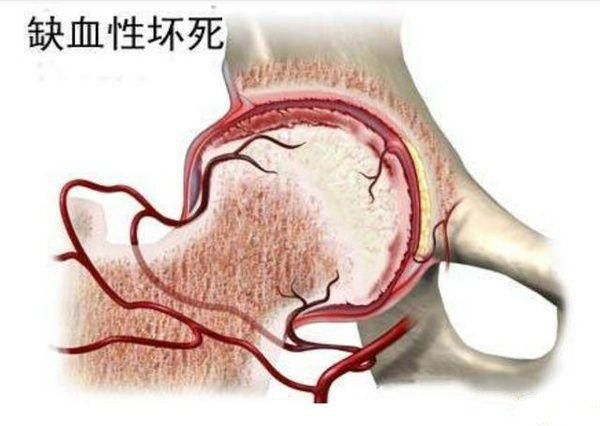 撞树锻炼致椎体坏死的警示